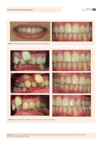 Fastbraces